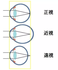 角膜塑形鏡