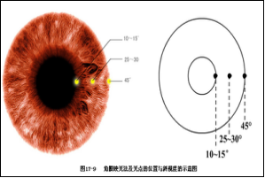 斜弱視