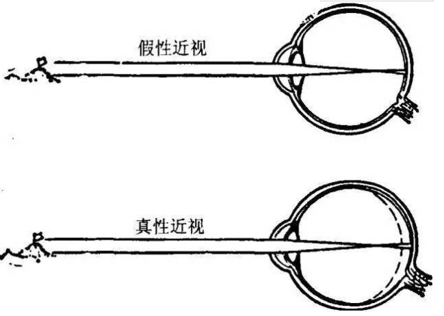 散瞳驗(yàn)光