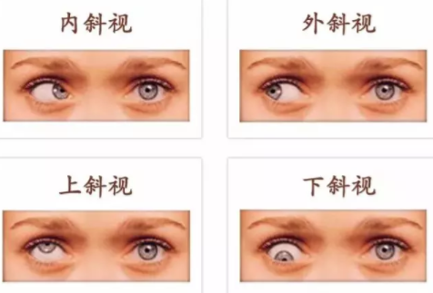 斜視和弱視可以永久治愈嗎？
