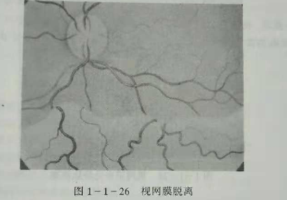 初級驗光師培訓(xùn)知識點：影響視覺的原因分析