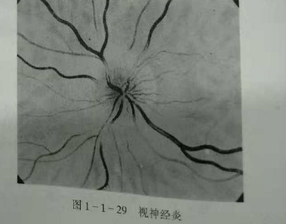 初級驗光師培訓(xùn)知識點：影響視覺的原因分析