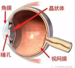 眼科專家趙娟：家長如何自查孩子有沒有先天性白內(nèi)障