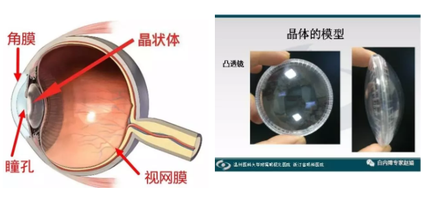 眼科專家趙娟：家長如何自查孩子有沒有先天性白內(nèi)障