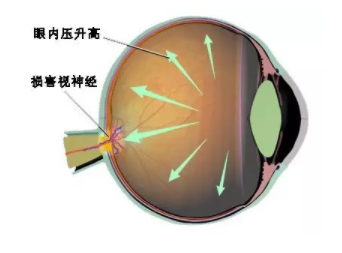 溫醫(yī)大梁遠(yuǎn)波教授：大部分失明青光眼患者因就診不及時(shí)所致 | 世界青光眼日