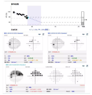 溫醫(yī)大梁遠(yuǎn)波教授：大部分失明青光眼患者因就診不及時(shí)所致 | 世界青光眼日