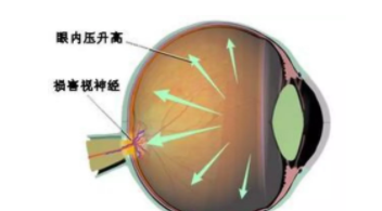 驗(yàn)光師培訓(xùn)中老年人如何預(yù)防青光眼