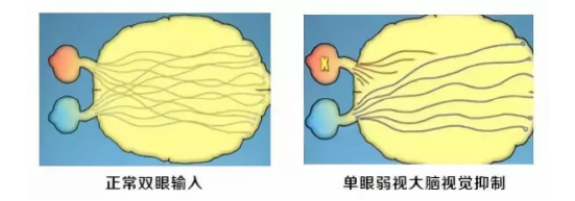 眼視光科普成人的弱斜視會影響正常生活嗎？