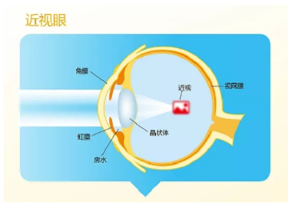 深圳驗(yàn)光師培訓(xùn)近視一定會(huì)遺傳嗎？