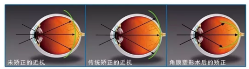 驗(yàn)光師帶您了解角膜塑形鏡的來龍去脈