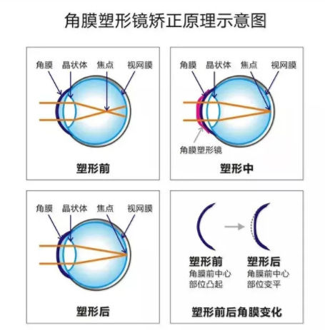 驗(yàn)光師帶您了解角膜塑形鏡的來龍去脈