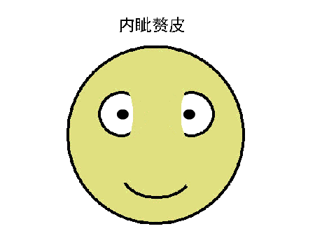 驗光配鏡中遇到的20多種斜視眼位特點