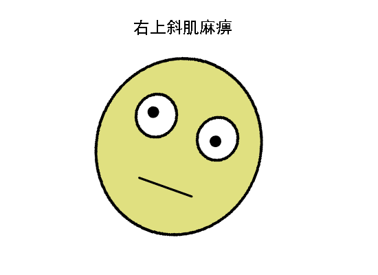 驗光配鏡中遇到的20多種斜視眼位特點