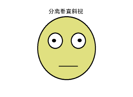 驗光配鏡中遇到的20多種斜視眼位特點