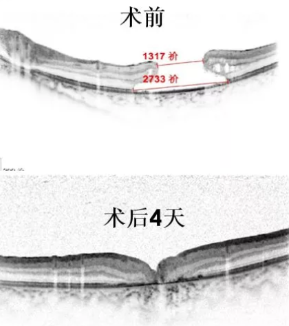 11歲患兒因激光筆損害視網(wǎng)膜造成罕見巨大黃斑裂孔，溫醫(yī)大眼視光成功治愈