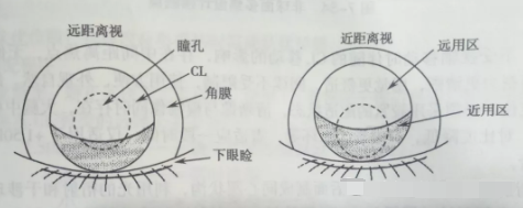天津市眼科醫(yī)院視光中心張姝賢主任：多焦點軟性接觸鏡矯正老視的驗配要點