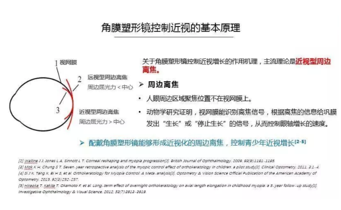【眼視光前沿】一種具有非球面基弧設(shè)計(jì)的角膜塑形鏡