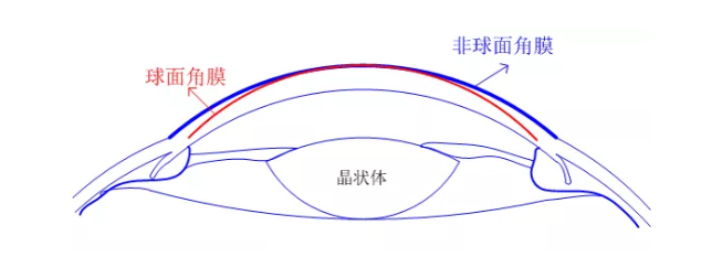 【眼視光前沿】一種具有非球面基弧設(shè)計(jì)的角膜塑形鏡